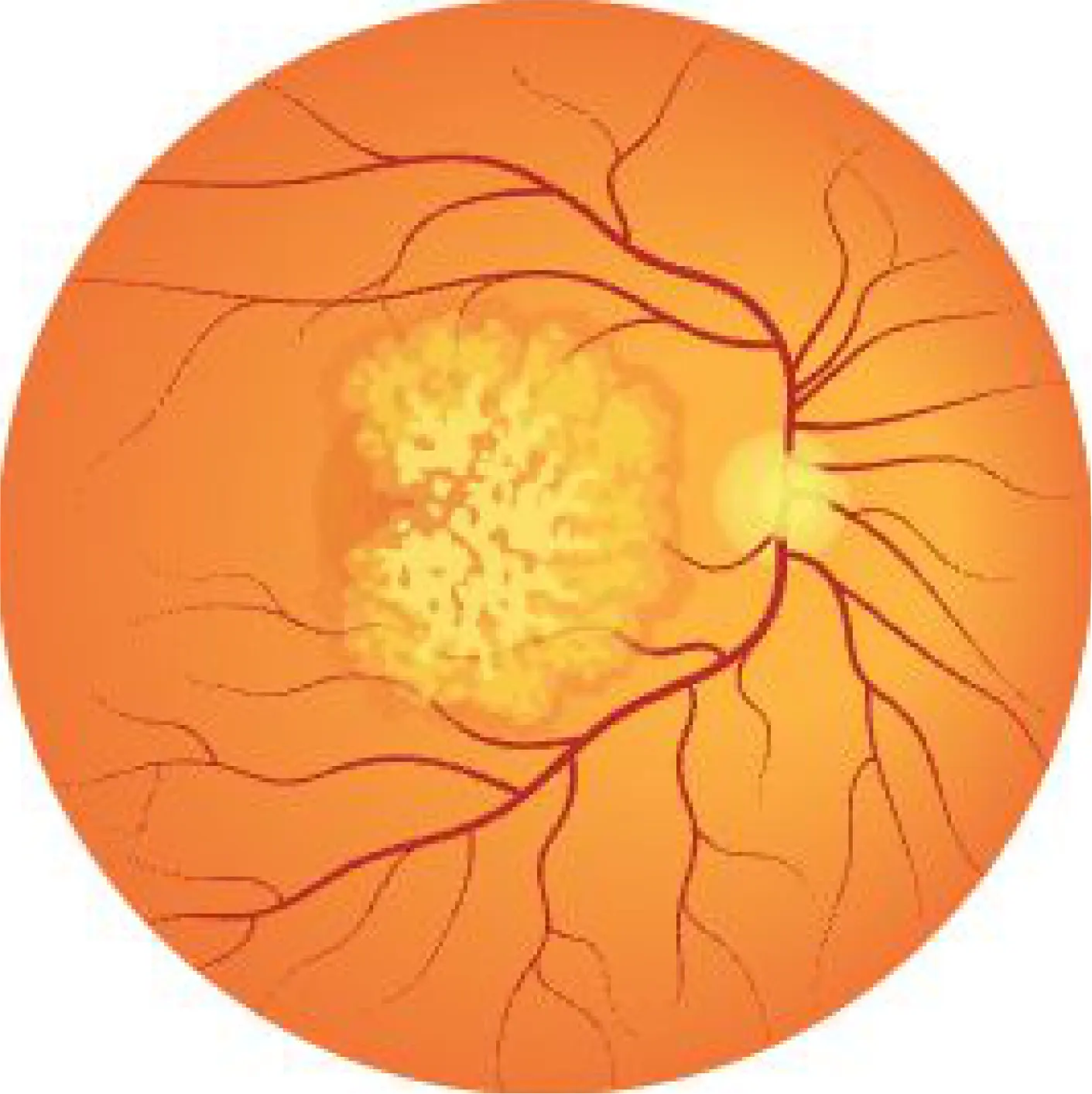 Image displaying Geographic atrophy